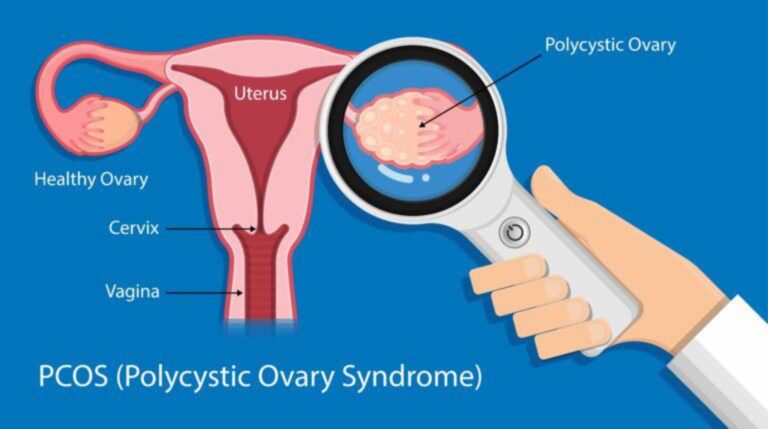Korelasi PCOS (Polycystic Ovary Syndrome) dengan Siklus Haid